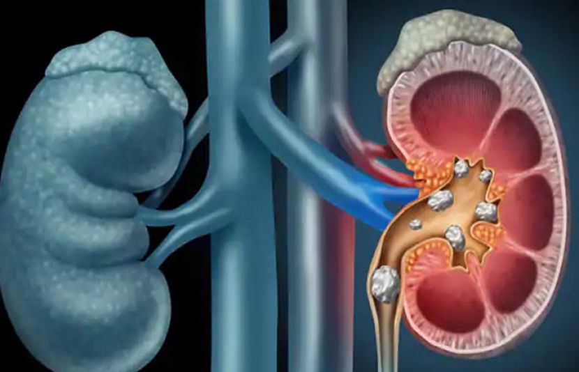 Remove 206 stones from the patients kidney